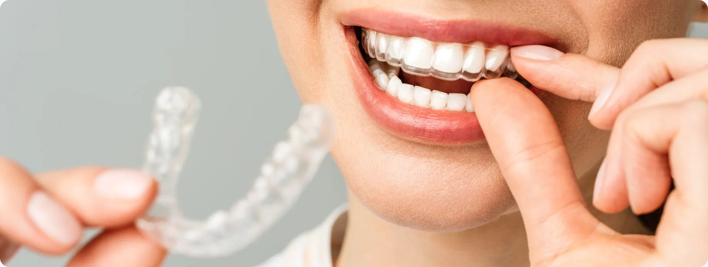 Pacientka si nasazuje průhledný dentální nákusek